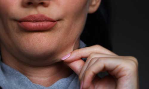 Everything you need to know about Kybella