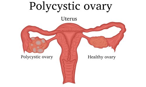 5 Things You Need to Know About Polycystic Ovary Syndrome