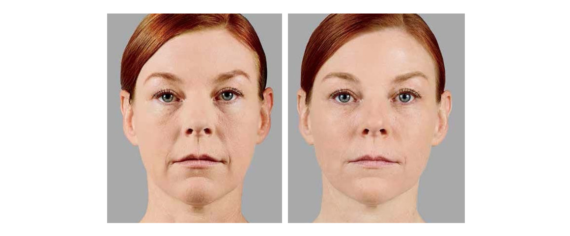 Dermal Fillers | Renew Health & Wellness | Multiple Locations