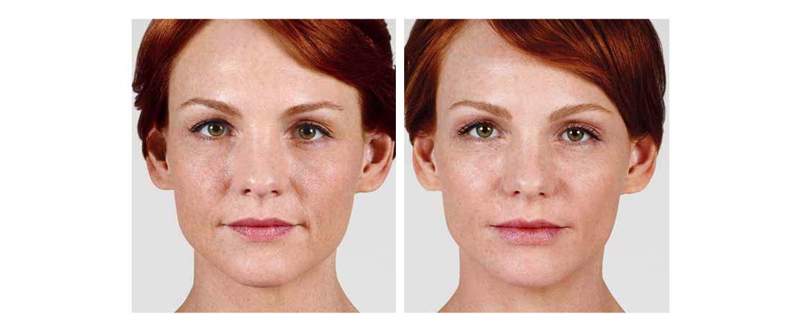 Dermal Fillers | Renew Health & Wellness | Multiple Locations