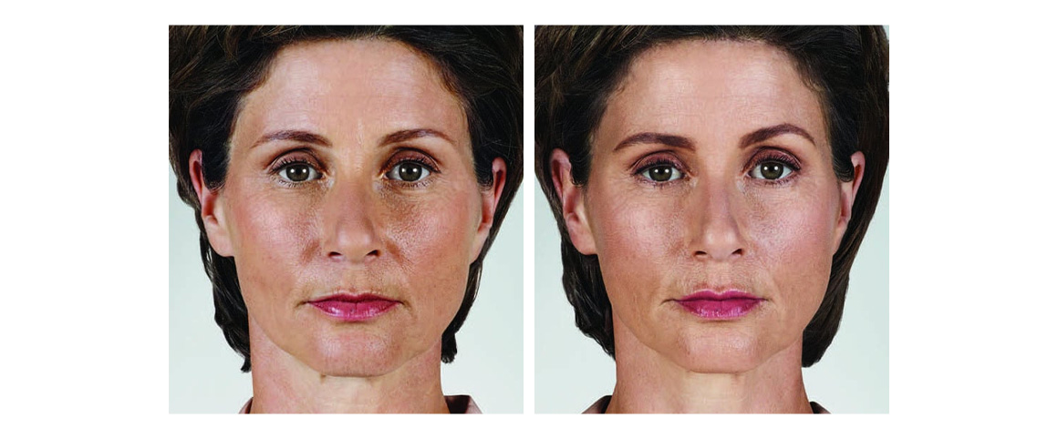 Dermal Fillers | Renew Health & Wellness | Multiple Locations
